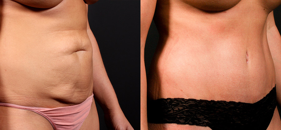 before and after images of a tummy tuck patient